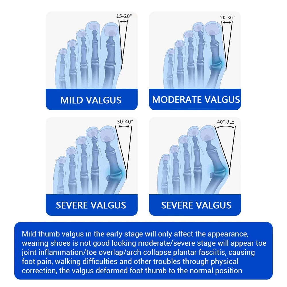 Moajaza Adjustable Bunion Toe Straightener With Silicone Pad